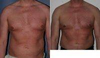 Male Breast Reduction By Dr Otto Joseph Placik, MD, Chicago Plastic Surgeon