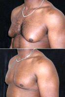 Male Breast Reduction By Dr Richard Silverman, MD, Newton Plastic Surgeon