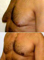 Male Breast Reduction By Dr Russell Sassani, MD, Fort Lauderdale Plastic Surgeon