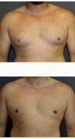 Male Breast Reduction By Dr Shelby Brantley, MD, Jackson Plastic Surgeon