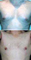Male Breast Reduction By Dr Stuart A. Linder, MD, FACS, Beverly Hills Plastic Surgeon