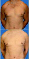 Male Breast Reduction By Dr William Franckle, MD, FACS, Voorhees Plastic Surgeon