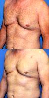 Male Breast Reduction By Dr. York Jay Yates, MD, Salt Lake City Plastic Surgeon