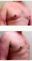 Male Breast Reduction For 30 Year Old Male By Doctor J. Jason Wendel, MD, FACS, Nashville Plastic Surgeon