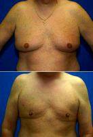 Male Breast Reduction (Gynecomastia Treatment) With Doctor Rodney A. Green, MD, Cleveland Plastic Surgeon