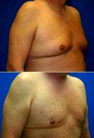 Male Breast Reduction (Gynecomastia Treatment) With Doctor Rodney A. Green, MD, Cleveland Plastic Surgeon