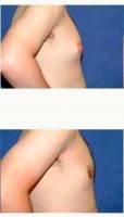Male Breast Reduction (Gynecomastia) With Doctor Samuel N. Pearl, MD, San Jose Plastic Surgeon