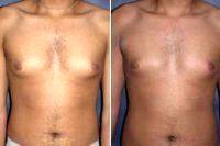 Male Breast Reduction Gynecomastia With Dr. Max Polo, MD, Miami Plastic Surgeon