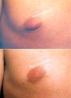 Male Breast Reduction-Gynecomastia. Reduced Size Of Nipples. By Doctor Ivan Thomas, MD , Los Angeles Plastic Surgeon