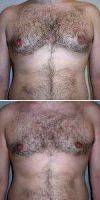 Male Breast Reduction With Doctor Carmen Kavali, MD, Atlanta Plastic Surgeon
