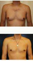 Male Breast Reduction With Doctor Gabriel Chiu, DO, Beverly Hills Plastic Surgeon