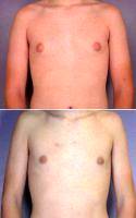 Male Breast Reduction With Doctor Grant Stevens, MD, Los Angeles Plastic Surgeon