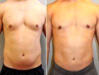 Male Breast Reduction With Doctor Stanley P. Gulin, MD, Naples Plastic Surgeon