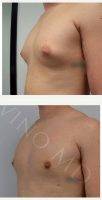 Male Breast Reduction With Dr Justin Yovino, MD, FACS, Beverly Hills Plastic Surgeon