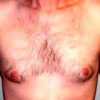 Male Breast Reduction With Dr Nicholas Tarola, MD, Nashville Plastic Surgeon