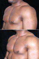 Male Breast Reduction With Dr Richard Silverman, MD, Newton Plastic Surgeon