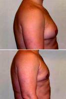 Male Breast Reduction With Dr. Carmen Kavali, MD, Atlanta Plastic Surgeon