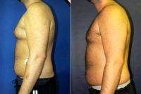 Male Chest Reduction By Dr Matthew Schulman, MD, New York Plastic Surgeon