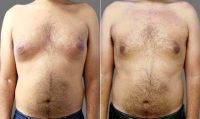 Male, Early 40s, Gynecomastia By Doctor Phillip R. Craft, MD, Miami Plastic Surgeon