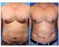 Male Liposuction And Gynecomastia With Dr Leif Rogers, MD, FACS, Beverly Hills Plastic Surgeon