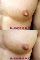 Male Nipple Reduction Before And After With Doctor Ronald Friedman, MD, Plano Plastic Surgeon (2)