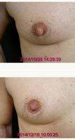 Male Nipple Reduction By Dr Ronald Friedman, MD, Plano Plastic Surgeon