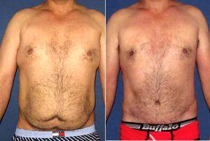 Male Tummytuck Breast Reduction Liposuction By Dr Ali Adibfar, MD, DDS, Toronto Plastic Surgeon