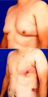 Man Treated With Gynecomastia - Moobs Reduction Surgery - Shown 1 Day After Surgery With Doctor Robert Caridi, MD, Austin Plastic Surgeon
