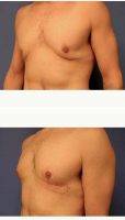 Man Treated With Male Breast Reduction By Doctor Javier Davila, MD, New Haven Plastic Surgeon
