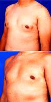 Man Treated With Male Breast Reduction Surgery With Dr Robert Caridi, MD, Austin Plastic Surgeon