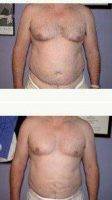 Man Treated With Male Breast Reduction With Dr. Hayley Brown, MD, FACS, Las Vegas Plastic Surgeon