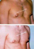 Moobs Reduction Surgery-Gynecomastia. Reduced Size Of Nipples. By Doctor Ivan Thomas, MD , Los Angeles Plastic Surgeon
