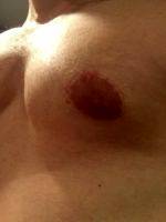 Photo Of Male Breast Reduction In Columbia SC