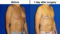 Scars After Gynecomastia 1 Day
