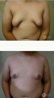 Teen Male Breast Reduction In Tucson By Doctor Jamie Moenster