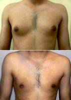 This Patient Had A Level II Gynecomastia Surgery With Dr Bivik Shah, MD, Columbus Plastic Surgeon