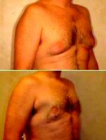 Treatment Of Gynecomastia By Doctor David B. Reath, MD, Knoxville Plastic Surgeon