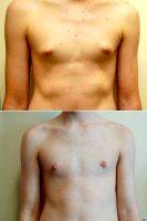 Young Male With puffy Nipples With Dr. Michael Marion, MD, Sandy Plastic Surgeon