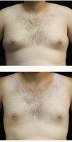 25 Year Old Man Treated With Male Breast Reduction By Doctor Stephen E. Zucker, MD, South Bend Plastic Surgeon