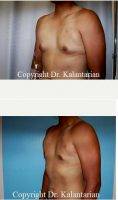 25 Year Old Man Treated With Male Breast Reduction By Dr. B. Kalantarian, MD, Orange County Plastic Surgeon