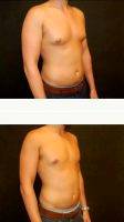 25 Year Old Man Treated With Male Breast Reduction With Dr. Jeffrey D. Wagner, MD, Indianapolis Plastic Surgeon