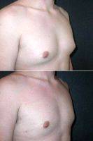 26 Year Old Male Underwent Male Breast Reduction With Dr Andres Taleisnik, MD, Orange County Plastic Surgeon