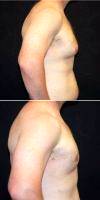 27 Year Old Man Treated With Male Breast Reduction With Doctor Jeffrey D. Wagner, MD, Indianapolis Plastic Surgeon