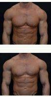 32 Year Old Male Bilateral Gynecomastia With Dr. Lawrence Iteld, MD, Chicago Plastic Surgeon