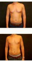 33 Year Old Male Treated With Male Breast Reduction By Dr Jeffrey D. Wagner, MD, Indianapolis Plastic Surgeon