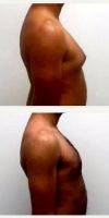 34 Year Old Man Treated With Male Breast Reduction With Dr. Jay M. Pensler, MD, Chicago Plastic Surgeon