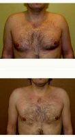 38 Year Old Man Treated With Male Breast Reduction By Dr. Gregory Turowski, MD, PhD, FACS, Chicago Plastic Surgeon