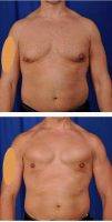 42 Year Old Man Treated With Gynecomastia By Dr Peter D. Geldner, MD, Chicago Plastic Surgeon