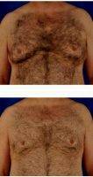 42 Year Old Man Treated With Gynecomastia With Dr. Peter D. Geldner, MD, Chicago Plastic Surgeon