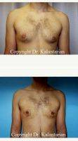 Doctor B. Kalantarian, MD, Orange County Plastic Surgeon 25 Year Old Man Treated With Male Breast Reduction